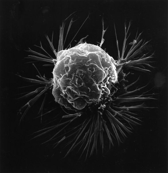 https://commons.wikimedia.org/wiki/File:Breast_cancer_cell_(2).jpg
